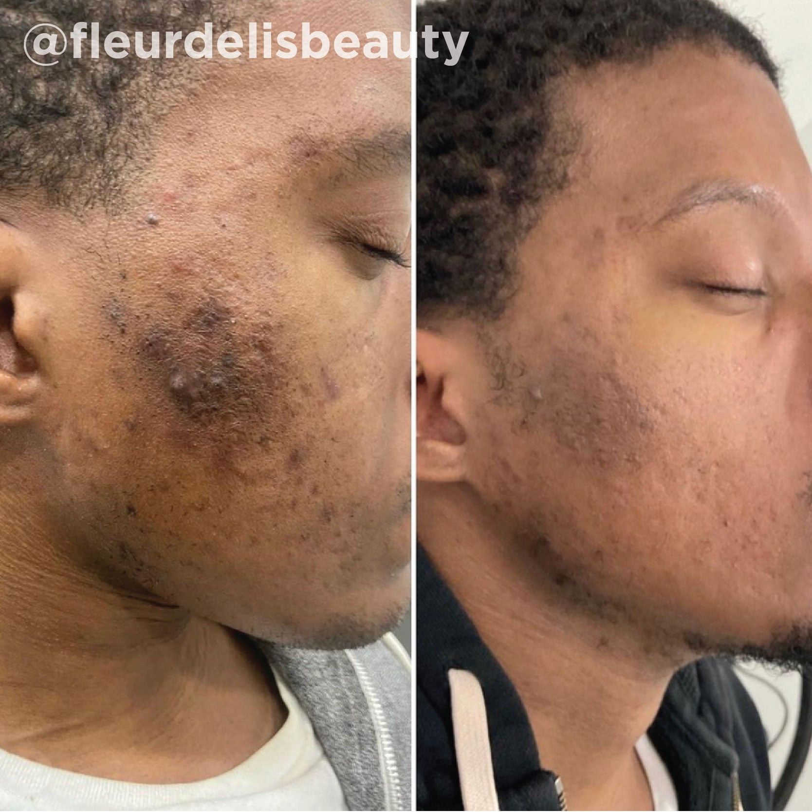 Pigmentation and uneven tone improved after a series of medical-grade peel treatments (VI Peel®). Representative manufacturer clinical case (VI Peel® by the Vitality Institute); not a Juniper patient. Individual results vary.