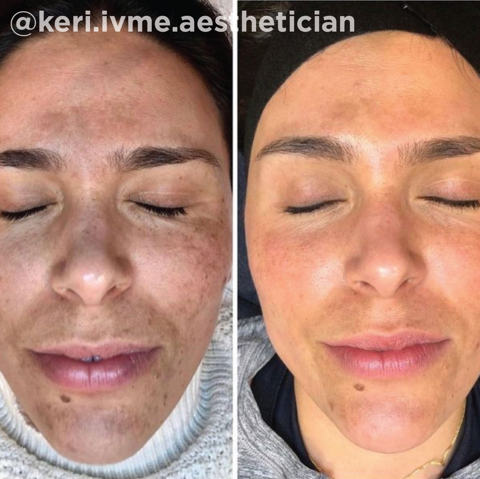Sun spots and dull tone brightened after a series of medical-grade peel treatments (VI Peel®). Representative manufacturer clinical case (VI Peel® by the Vitality Institute); not a Juniper patient. Individual results vary.