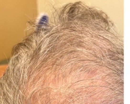 Hair regrowth after treatment - Men's thinning - crown, Juniper Dermatology