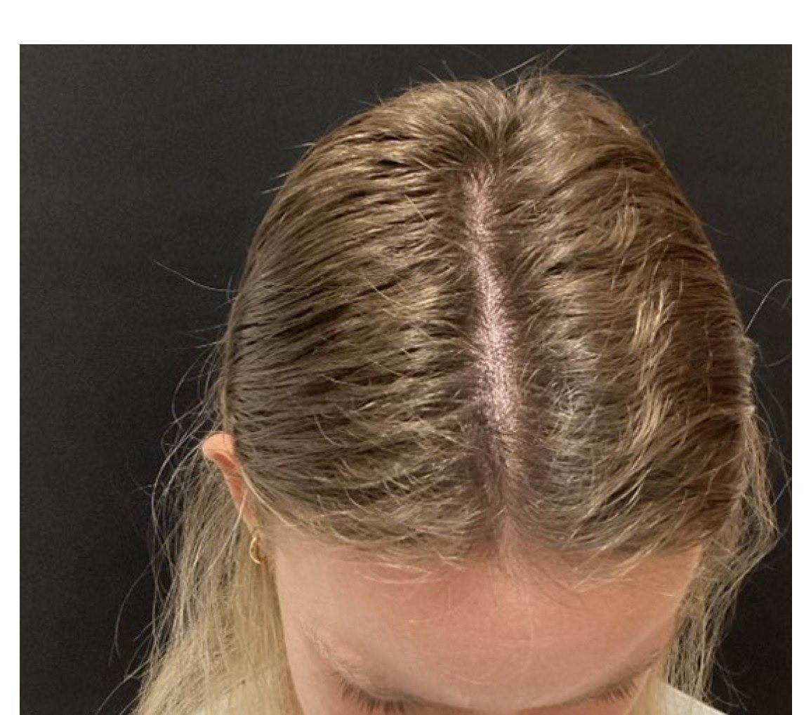 Hair regrowth after treatment - Thinning along the part, Juniper Dermatology