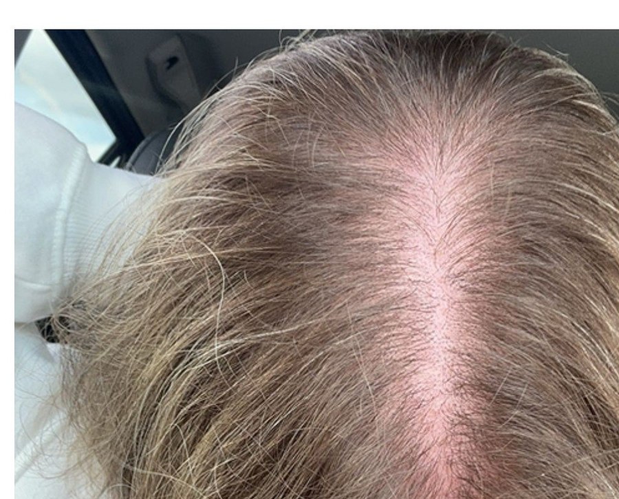 Hair loss before treatment - Thinning along the part, Juniper Dermatology
