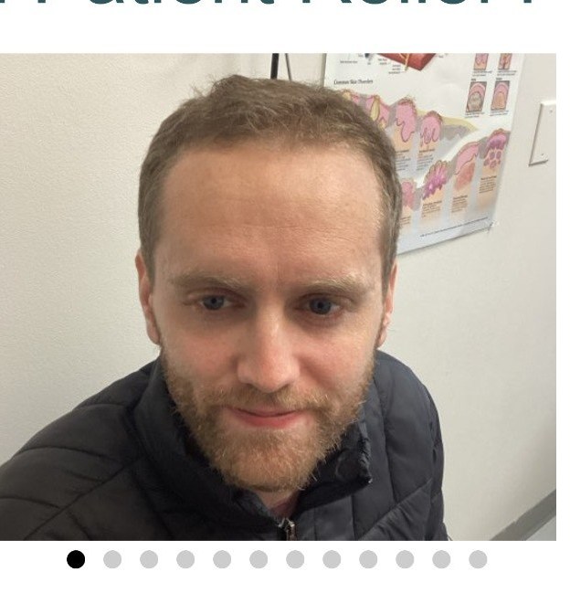 Hair regrowth after treatment - Men's thinning - frontal hairline, Juniper Dermatology