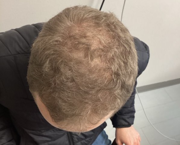 Hair regrowth after treatment - Men's thinning - crown, Juniper Dermatology