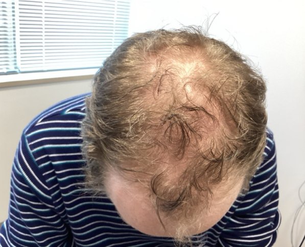 Hair loss before treatment - Men's thinning - crown, Juniper Dermatology