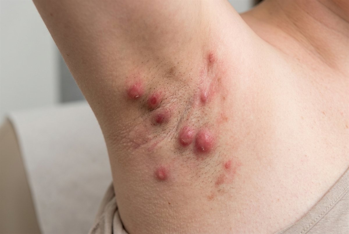 Representative clinical image of a hidradenitis suppurativa breakout — tender, inflamed nodules in a skin-fold area such as the underarm