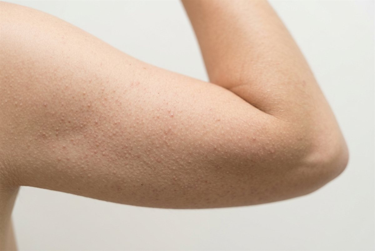 Representative clinical image of keratosis pilaris — tiny rough bumps clustered on the back of the upper arm