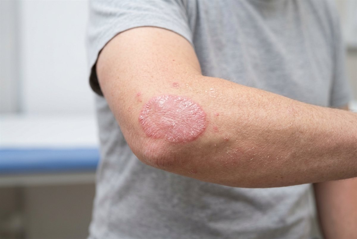 Close-up of a plaque psoriasis lesion on the elbow — raised red skin with silvery scale