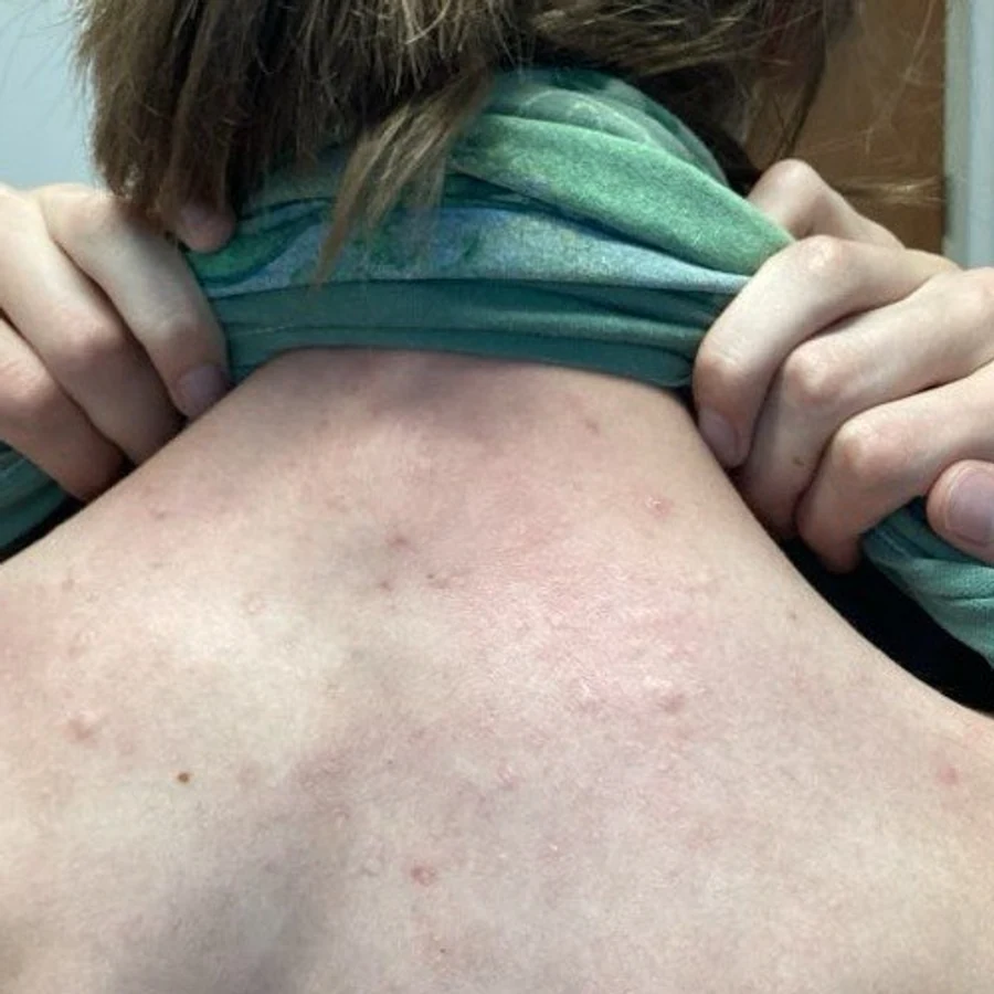 Acne after treatment at Juniper Dermatology
