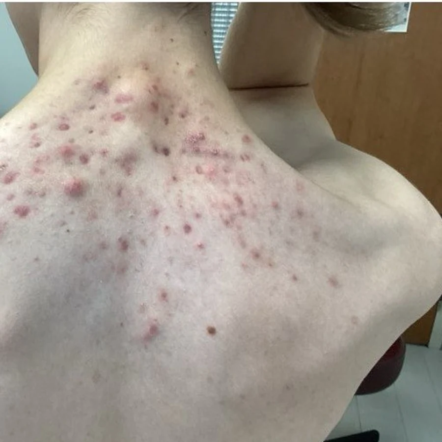 Acne before treatment at Juniper Dermatology