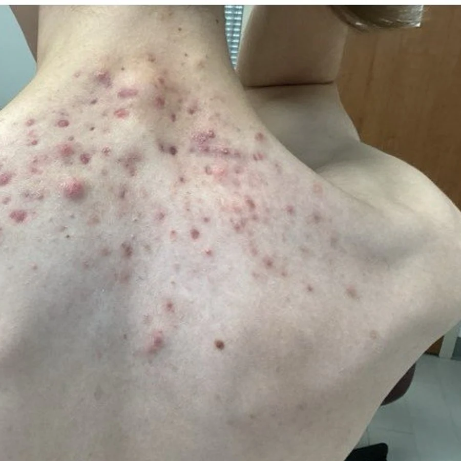 Acne before treatment at Juniper Dermatology