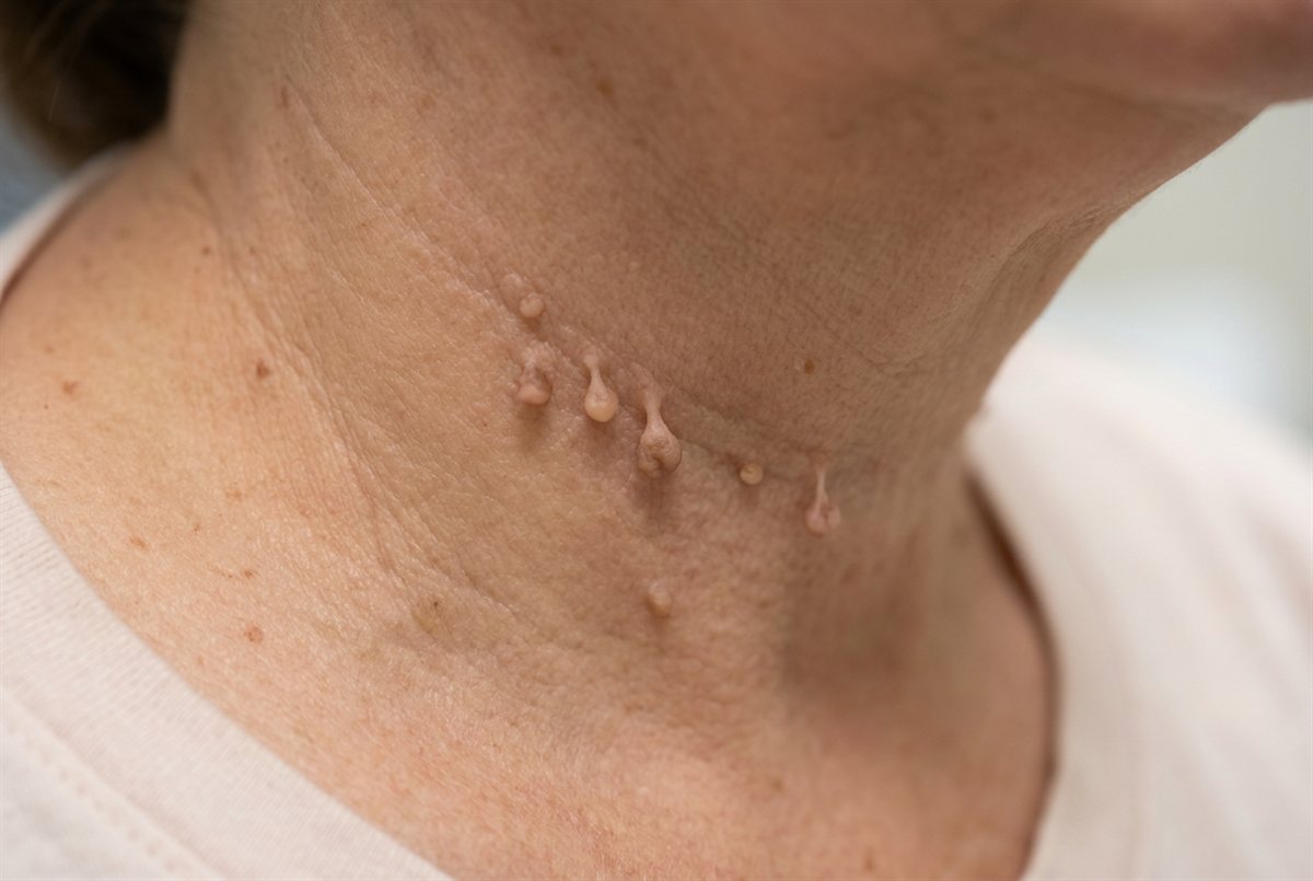 Representative clinical image of skin tags — small, soft, flesh-colored growths on thin stalks along the neck