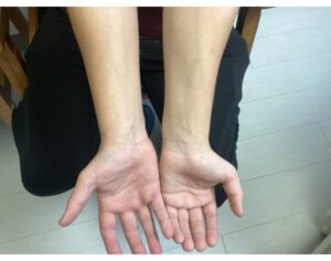 After eczema treatment in bend, OR