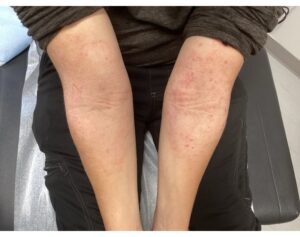 Psoriasis treatment in Bend