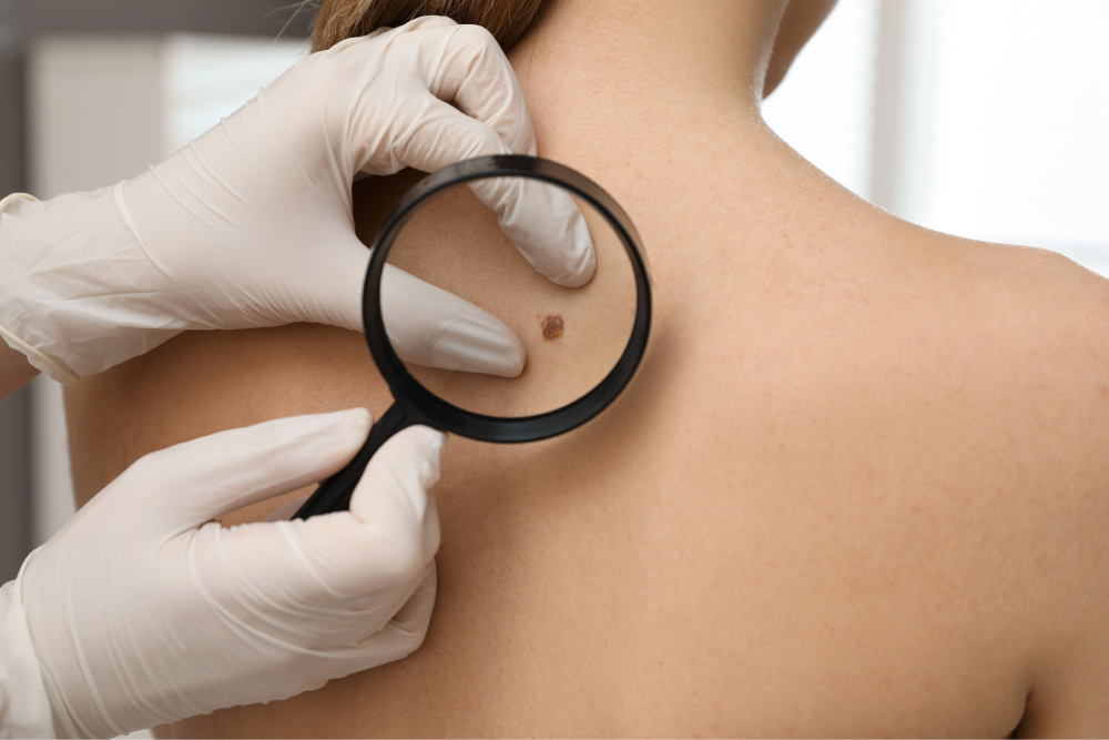 Melanoma And Skin Cancer Treatment In Bend OR Juniper Dermatology melanoma-and-skin-cancer-treatment-in-bend-or-juniper-dermatology