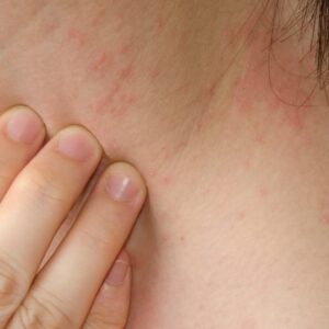 Patient before receiving eczema treatment in Bend, OR