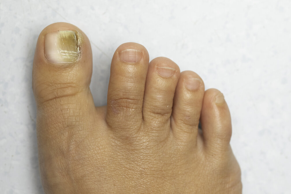 Patient before nail fungus treatment in bend, or