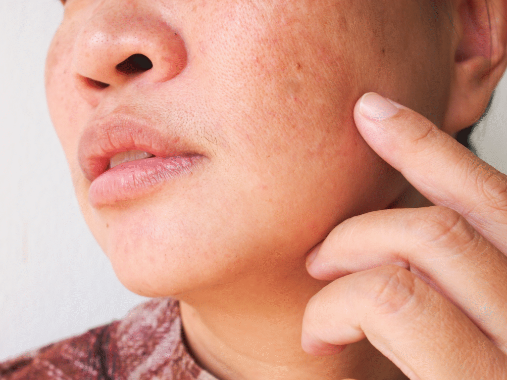 Patient with melasma on the face in Bend, OR
