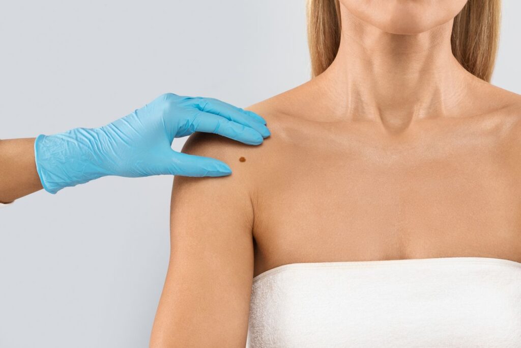 Patient getting a mole checked at a skin cancer screening in Bend