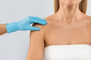 Patient getting a mole checked at a skin cancer screening in Bend