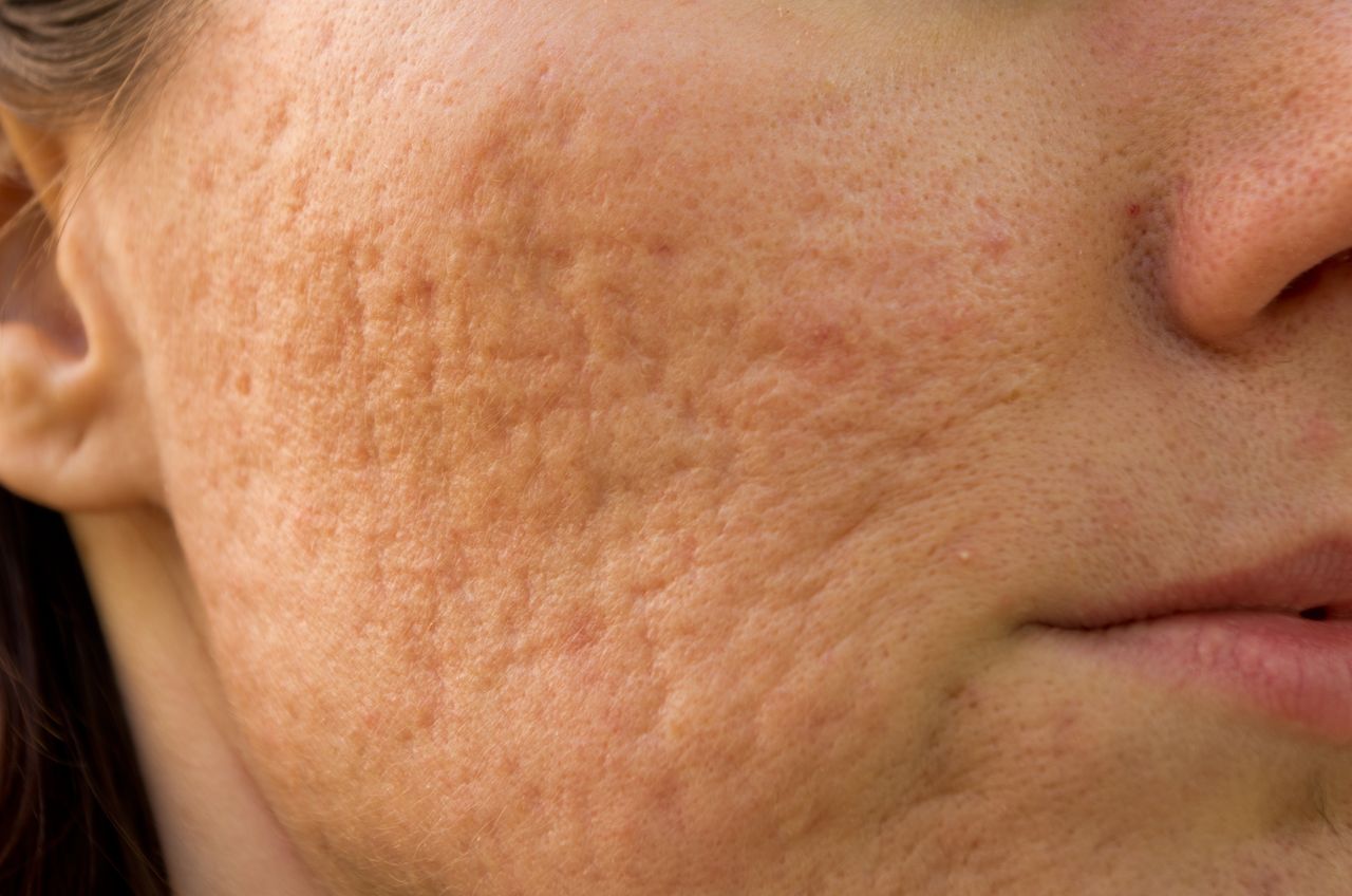 Before acne scar treatment in Bend, OR